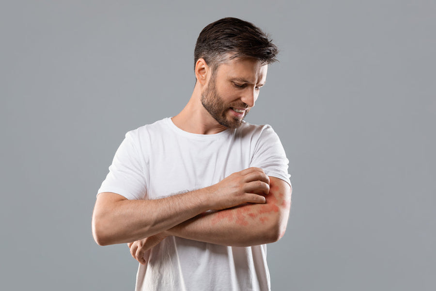 Struggling With Acne, Eczema or Weight Gain? Look at Your Liver